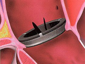 Механический протез в аортальной позиции
